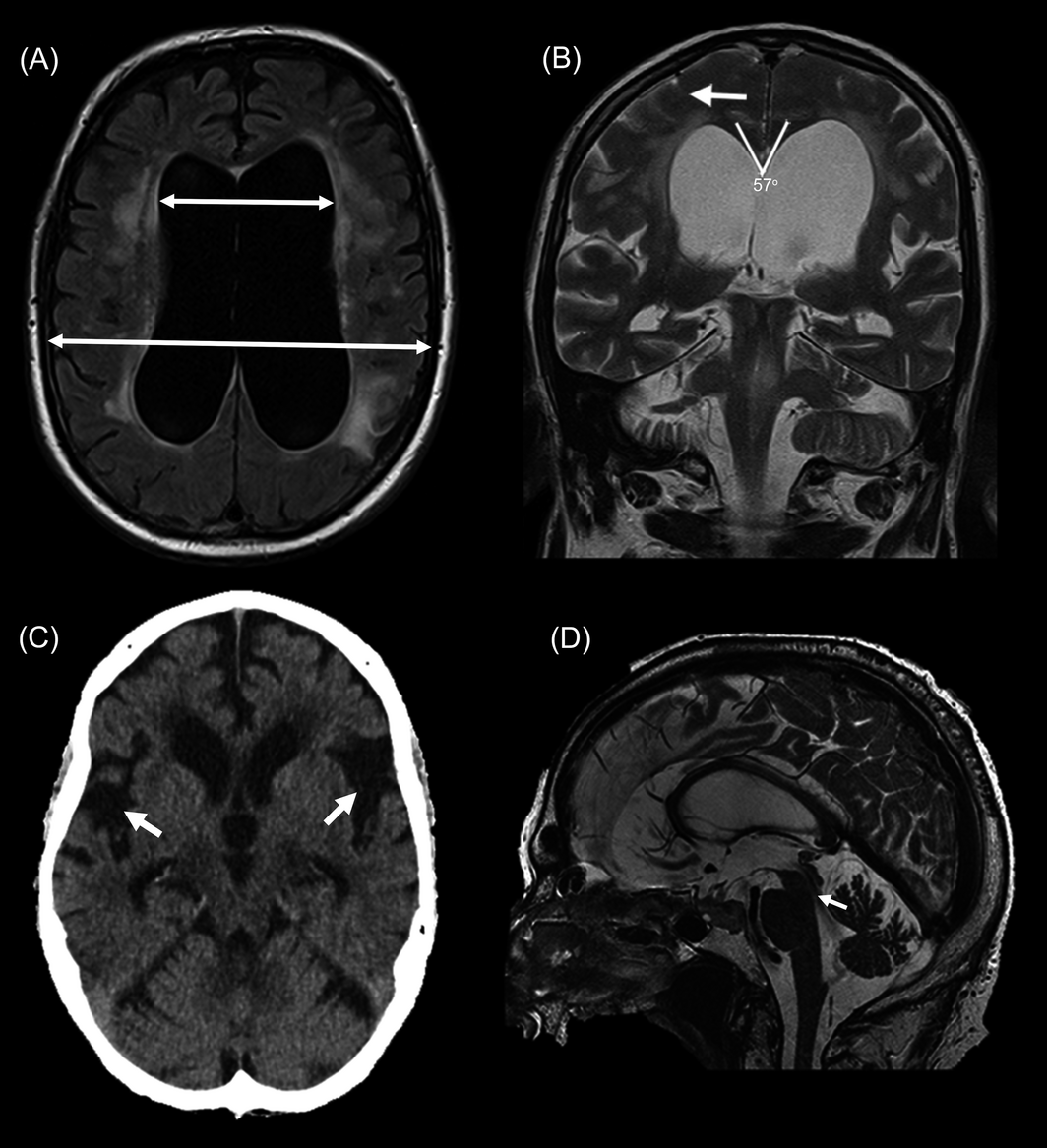 What is the definition of ventriculomegaly?