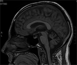 Sagittal T1-weighted MRI showing mild cerebellar atrophy.
