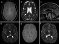 MRI findings of family 1 and 2.