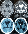 Preoperative MRI of brain (fluid attenuation inversion recovery sequence axial [A] and T2 coronal [B]) and CT scans of the head 