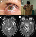  A) Kayser-Fleischer ring over the cornea. (B) Wing beating tremor in the patient. (C) Face of the Giant Panda in the midbrain. (D) Face of the Miniature Panda in the pons. The authors confirm that patient consent was obtained for publication.