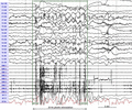 EEG/EMG recording showing cortical reflex myoclonus.
